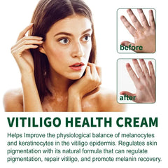 Vitilgo Health Cream Remove Vitiligo White Spots Leukoplakia Pigmentation Melanin Promoting Natural Relief Skin Treatment Cream Vitilgo Health Cream Remove Vitiligo White Spots Leukoplakia Pigmentation Melanin Promoting Natural Relief Skin Treatment Cream
