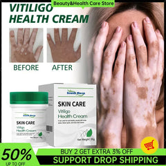 Vitilgo Health Cream Remove Vitiligo White Spots Leukoplakia Pigmentation Melanin Promoting Natural Relief Skin Treatment Cream Vitilgo Health Cream Remove Vitiligo White Spots Leukoplakia Pigmentation Melanin Promoting Natural Relief Skin Treatment Cream