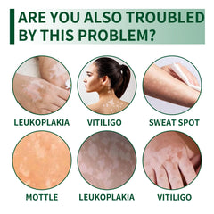 Vitilgo Health Cream Remove Vitiligo White Spots Leukoplakia Pigmentation Melanin Promoting Natural Relief Skin Treatment Cream Vitilgo Health Cream Remove Vitiligo White Spots Leukoplakia Pigmentation Melanin Promoting Natural Relief Skin Treatment Cream