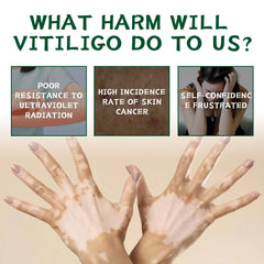 Vitilgo Health Cream Remove Vitiligo White Spots Leukoplakia Pigmentation Melanin Promoting Natural Relief Skin Treatment Cream Vitilgo Health Cream Remove Vitiligo White Spots Leukoplakia Pigmentation Melanin Promoting Natural Relief Skin Treatment Cream
