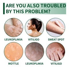 Vitilgo Health Cream Remove Vitiligo White Spots Leukoplakia Pigmentation Melanin Promoting Natural Relief Skin Treatment Cream Vitilgo Health Cream Remove Vitiligo White Spots Leukoplakia Pigmentation Melanin Promoting Natural Relief Skin Treatment Cream