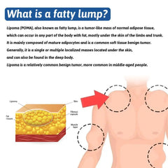 Lipoma Removal Spray Anti Tumor Skin Swelling Pain Lipolysis Cellulite Treatment Fibroma Subcutaneous Fat Lump Relief Cream 50ml
