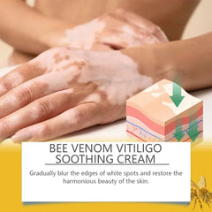 Bee Venom Vitiligo Soothing Cream Repair Leukoplakia Reduce Pigment Evens Skin Tone Treatment White Spot Disease Cream Body Care