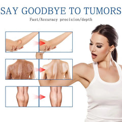 Lipoma Removal Spray Anti Tumor Skin Swelling Pain Lipolysis Cellulite Treatment Fibroma Subcutaneous Fat Lump Relief Cream 50ml