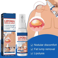 Lipoma Removal Spray Anti Tumor Skin Swelling Pain Lipolysis Cellulite Treatment Fibroma Subcutaneous Fat Lump Relief Cream 50ml