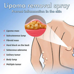 Lipoma Removal Spray Anti Tumor Skin Swelling Pain Lipolysis Cellulite Treatment Fibroma Subcutaneous Fat Lump Relief Cream 50ml