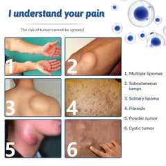 Lipoma Removal Spray Anti Tumor Skin Swelling Pain Lipolysis Cellulite Treatment Fibroma Subcutaneous Fat Lump Relief Cream 50ml