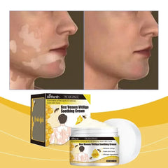 Bee Venom Vitiligo Soothing Cream Repair Leukoplakia Reduce Pigment Evens Skin Tone Treatment White Spot Disease Cream Body Care
