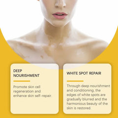 Bee Venom Vitiligo Soothing Cream Repair Leukoplakia Reduce Pigment Evens Skin Tone Treatment White Spot Disease Cream Body Care