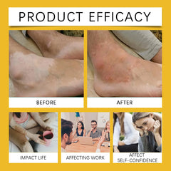 Bee Venom Vitiligo Soothing Cream Repair Leukoplakia Reduce Pigment Evens Skin Tone Treatment White Spot Disease Cream Body Care
