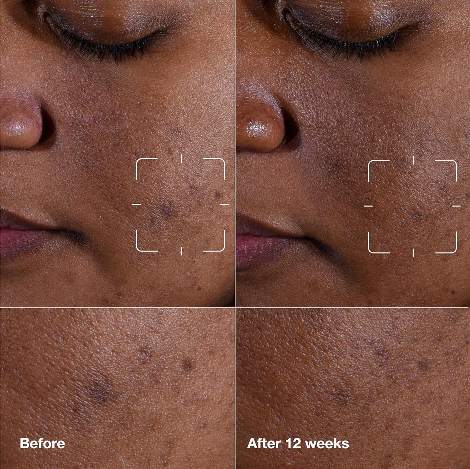 Clinique Even Better Clinical™ Radical Dark Spot Corrector + Interrupter - Mumzar