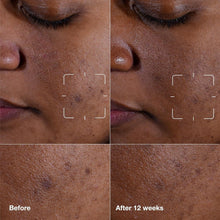 Close-up skin on cheek with dark spots, measurement brackets for treatment area