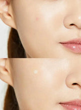 Hydrocolloid spot patches applied to cheek skin near lips and jaw