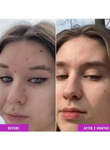Niacinamide serum before-and-after skin results on face, two panel view