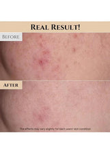 Real result! before-and-after skin panel with acne and texture comparisons