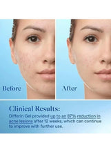 Differin Gel before and after acne skin result with face close-up