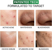 Acne spot correction skin comparison showing active acne, whiteheads, blackheads