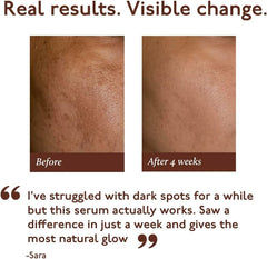 Asaya 2% Kojic Acid + 1% Alpha Arbutin Face Serum | Advanced Brightening & Pigmentation Care | Dark Spot & Uneven Skin Tone Correcting Serum | Lightweight Formula | Radiant Skin | 30ml