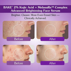 BAKE 2% Kojic Acid Face Serum with 5% Niacinamide & 2% Glycolic Acid – Pigmentation, Dark Spot & Tan Care – 30ml