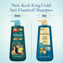 Two Kesh King Gold anti-dandruff shampoo bottles with pump, before-and-after