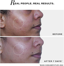 Acne before-and-after on face with circled area and 'after 7 days' label