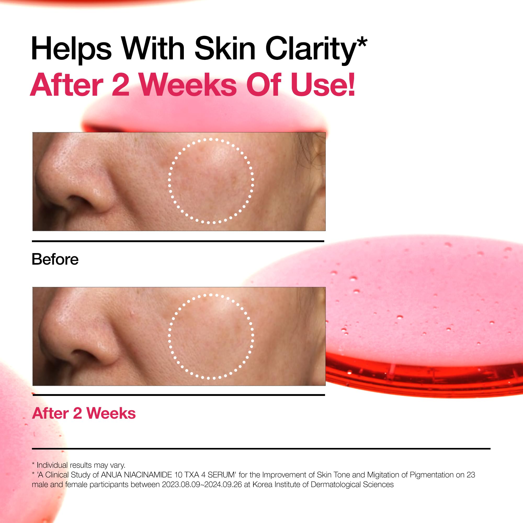 Before and after comparison showing improved skin clarity after 2 weeks using tranexamic acid serum fragrance free