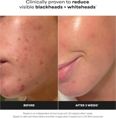 Paula's Choice SKIN PERFECTING 2% BHA Liquid Exfoliant - Face Exfoliating Peel Fights Blackheads & Enlarged Pores - with Salicylic Acid - Combination & Oily Skin