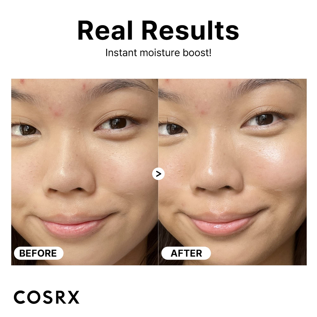 Before and after face photos showing dewier skin and reduced redness after using COSRX hyaluronic acid serum UAE for hydration