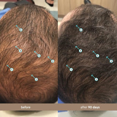 Before and after images showing hair growth improvement using hair density serum for men over 90 days