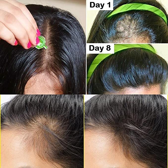 Evion 400mg softgels for skin vitamin E capsules applied to scalp showing hairline before and after Day 1 to Day 8