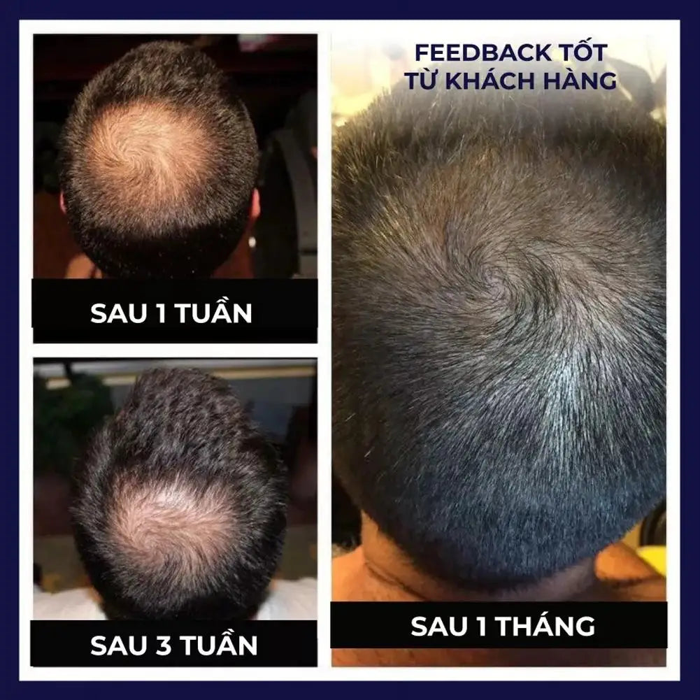 Before and after results of Mumzar hair growth spray for hair loss showing improved hair density over one month