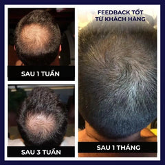 Before and after results of Mumzar hair growth spray for hair loss showing improved hair density over one month