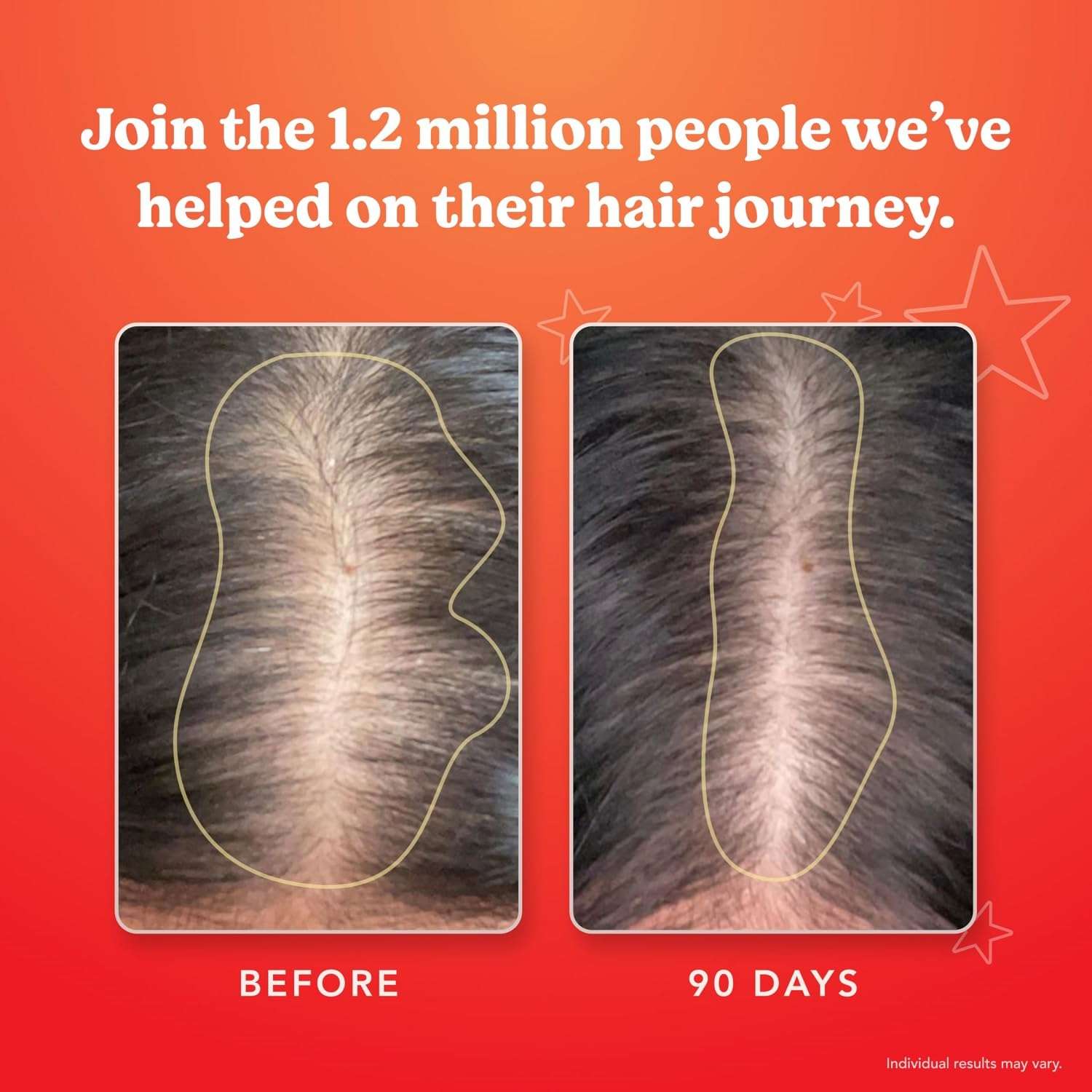 HAIRtamin before and after scalp comparison showing fuller part after 90 days using gluten-free hair growth vitamins