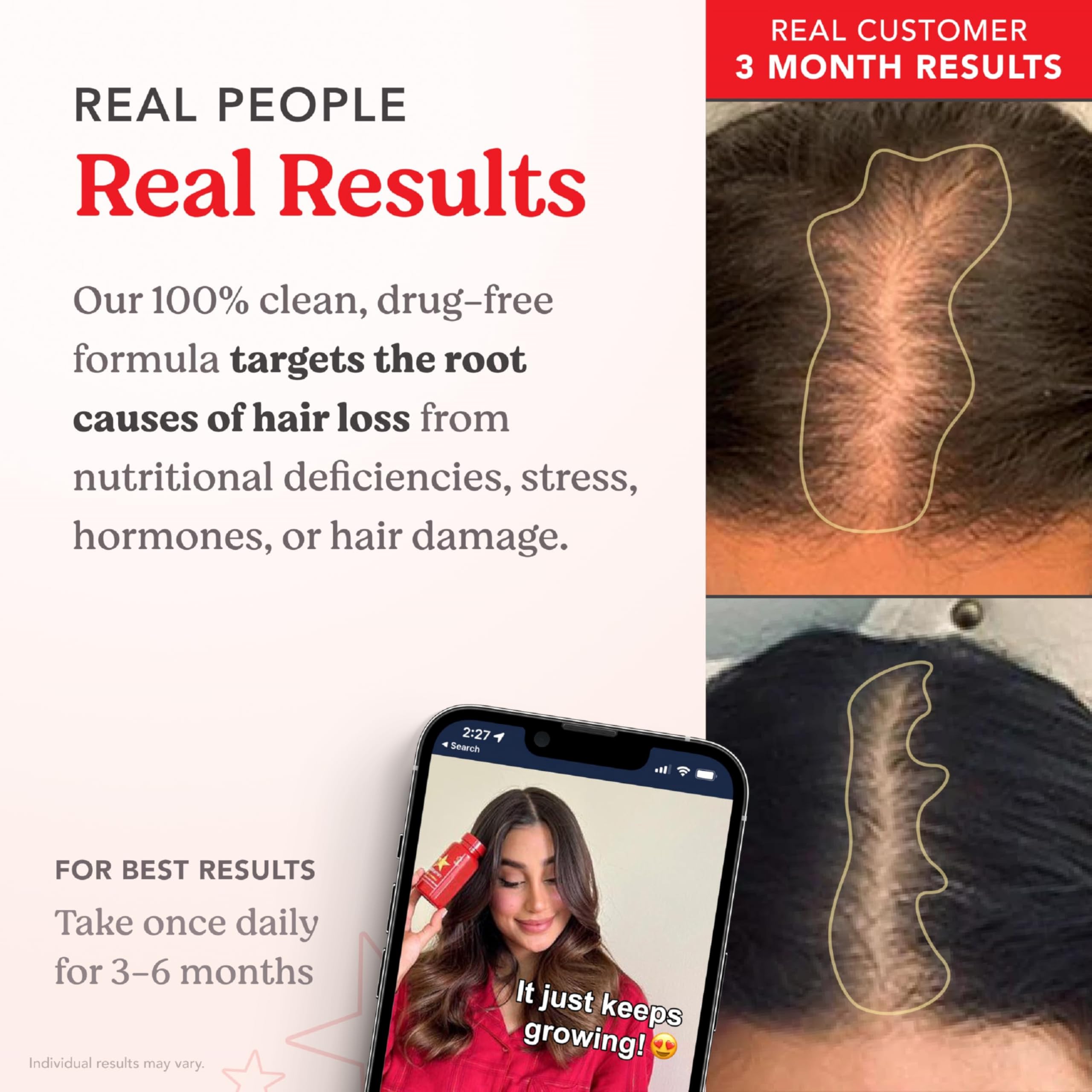 HAIRtamin ad with before and after scalp photos and woman holding bottle, Real Results, gluten-free hair growth vitamins