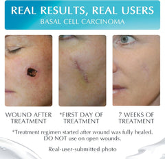 Three images showing healing progress with medical grade silicone gel for scars after a basal cell carcinoma treatment