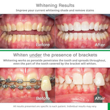 Opalescence Go 15% tooth whitener before-and-after whitening results on teeth