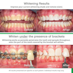 Opalescence Go hydrogen peroxide whitener before and after photos showing teeth whitening results with and without braces