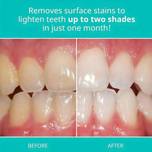Teeth whitening before-and-after panel with glossy front teeth