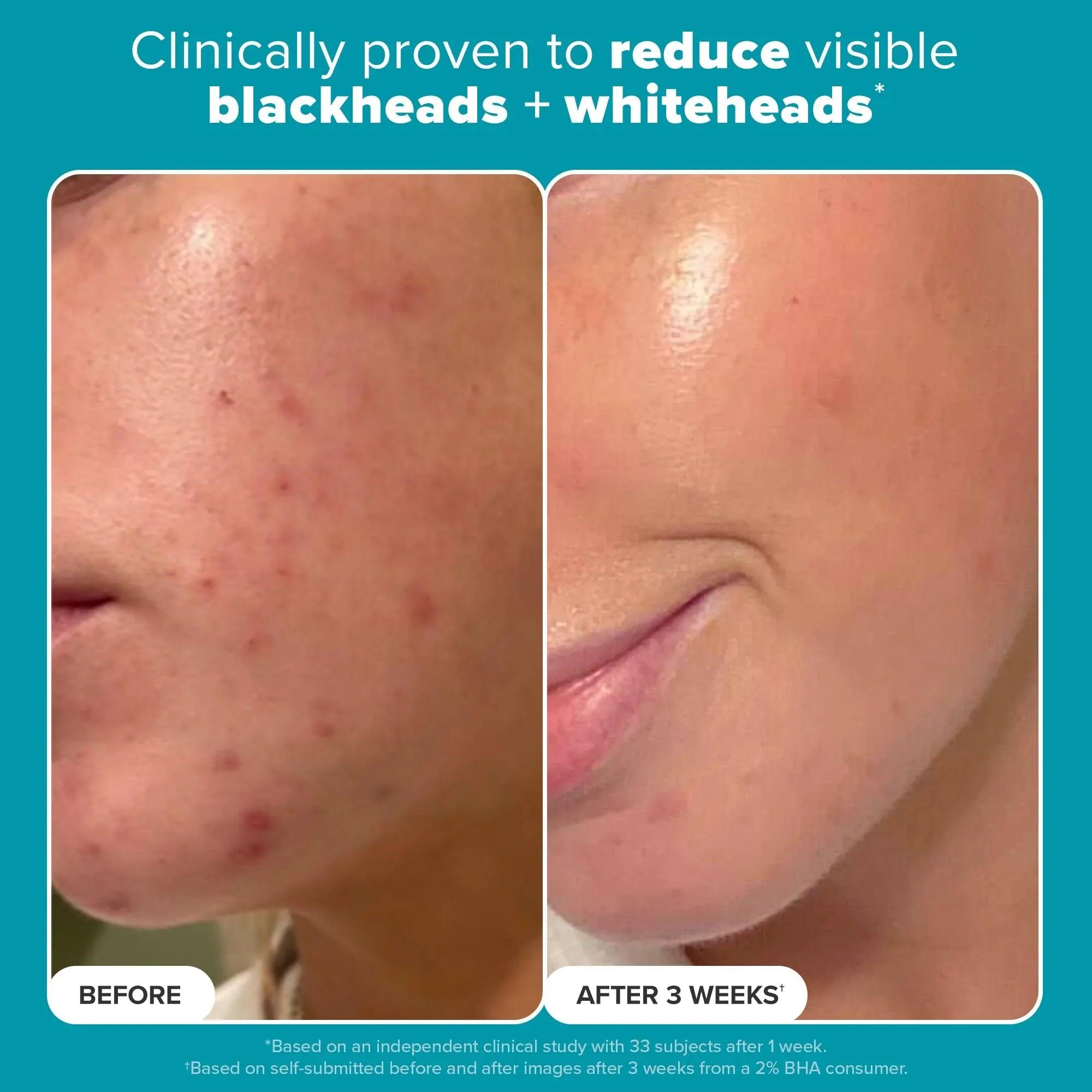 Exfoliant results before-and-after close-up of chin and cheeks