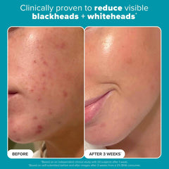 Exfoliant results before-and-after close-up of chin and cheeks