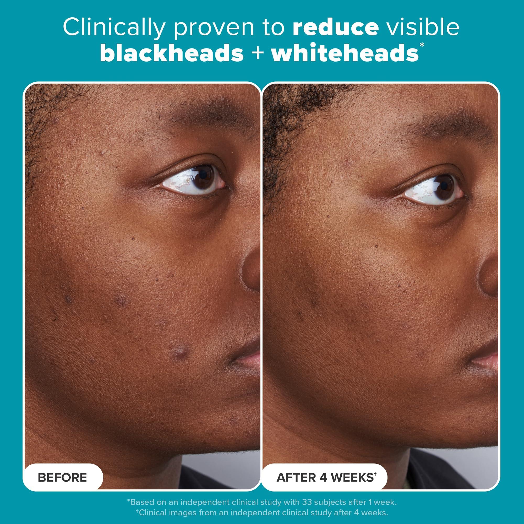 Exfoliant results before-and-after face photos showing reduced blackheads