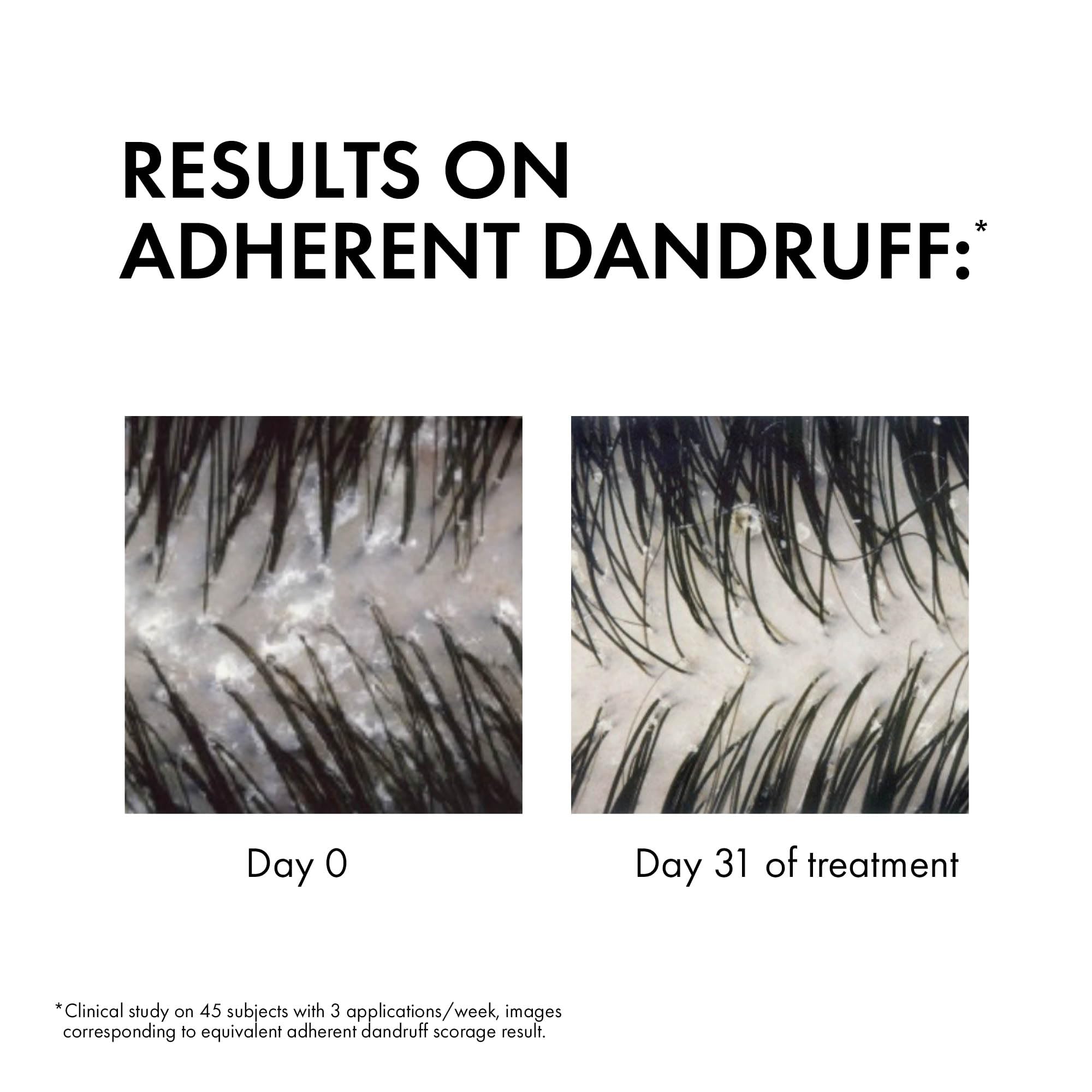 Before and after results of Vichy Dercos anti dandruff shampoo showing reduction in dandruff after 31 days