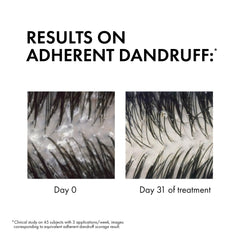 Before and after results of Vichy Dercos anti dandruff shampoo showing reduction in dandruff after 31 days