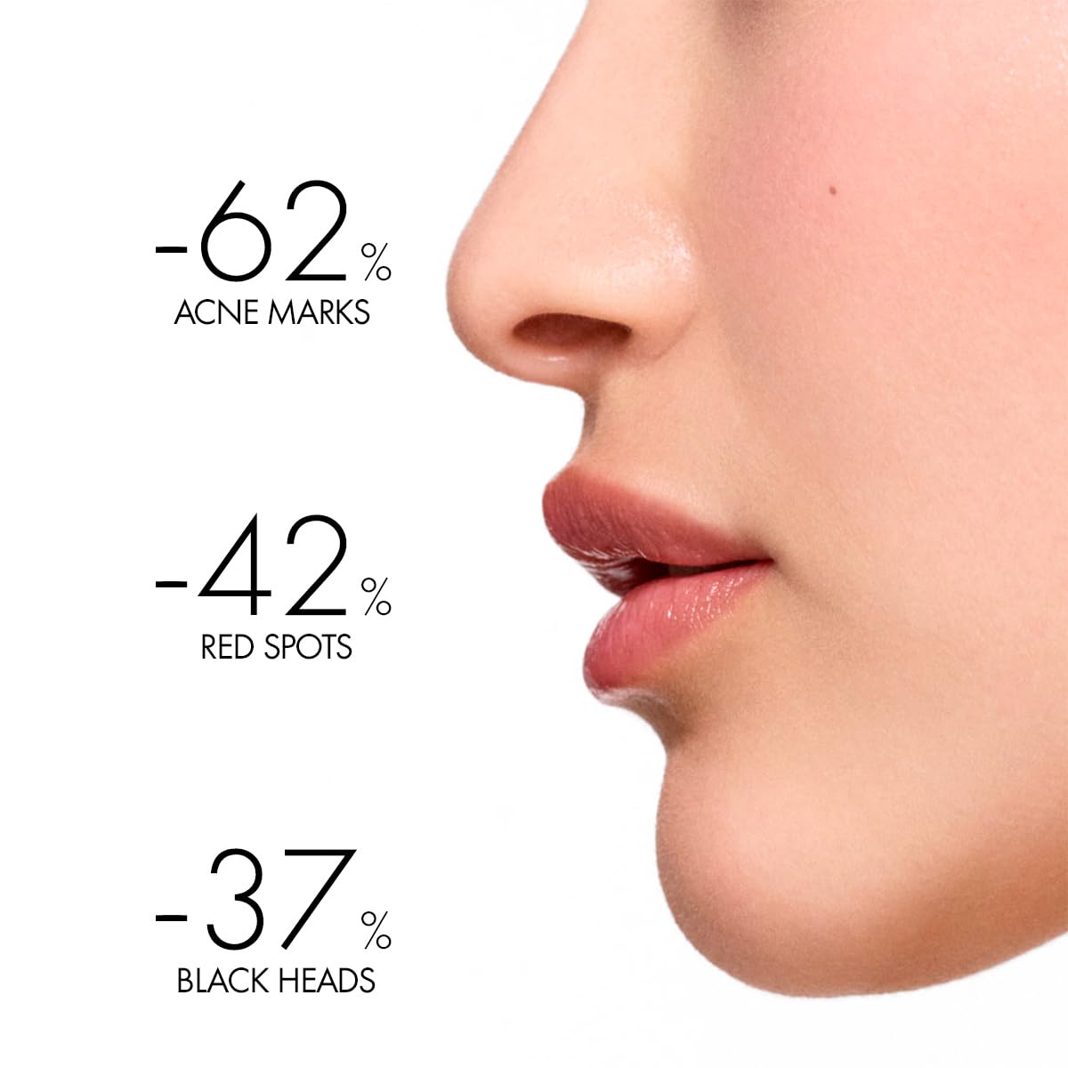 Before and after results showing Vichy Phytosolution Dual Moisturizer for oily skin reducing acne marks and spots