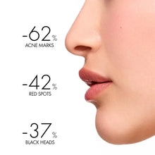 Side face with text: 62% acne marks, 4% red spots, 3% blackheads