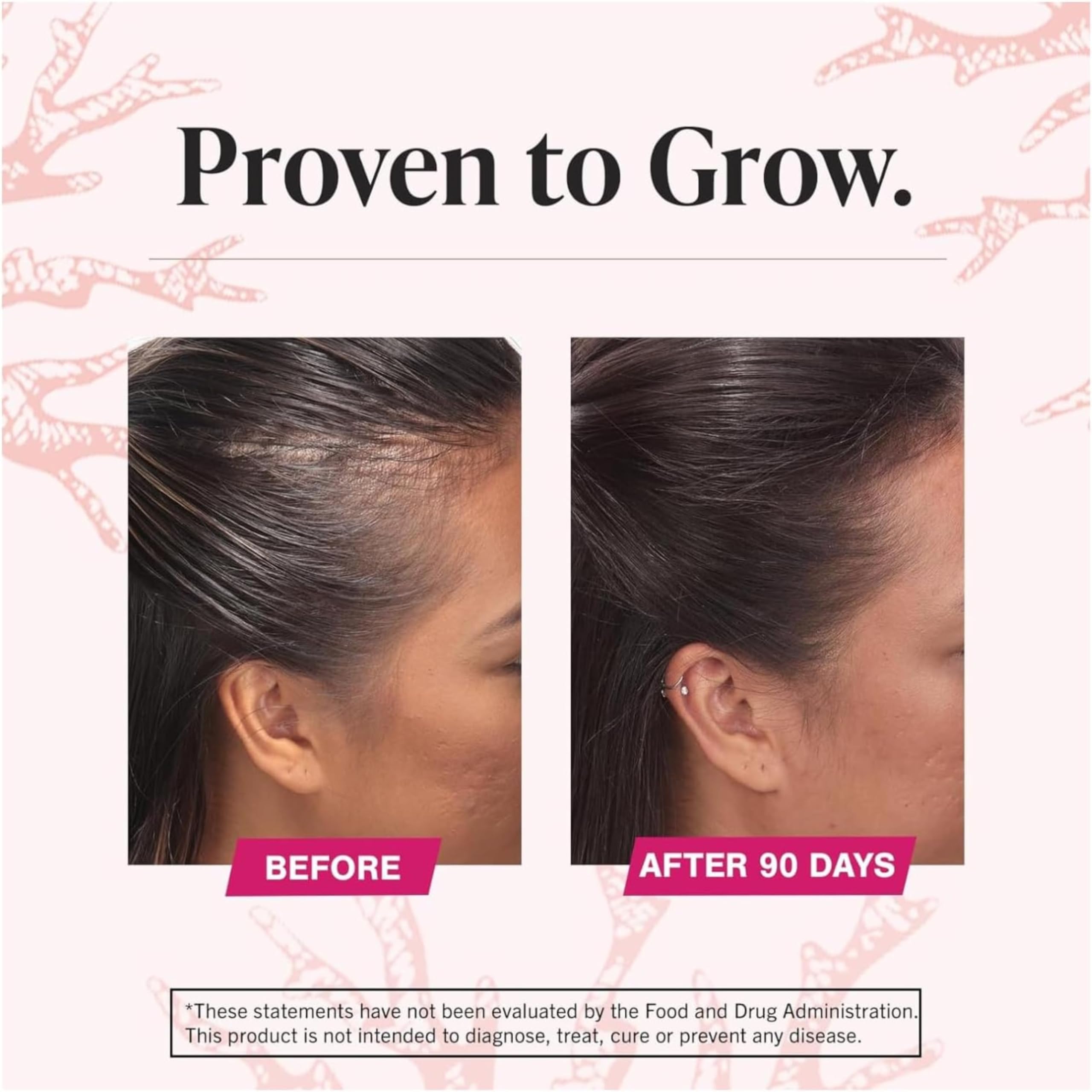 Side by side before and after showing fuller hairline after 90 days using Viviscal hair growth supplement for women