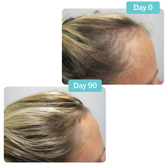 Before and after Day 0 to Day 90 hairline improvement using Viviscal PRO hair growth supplements showing fuller hair