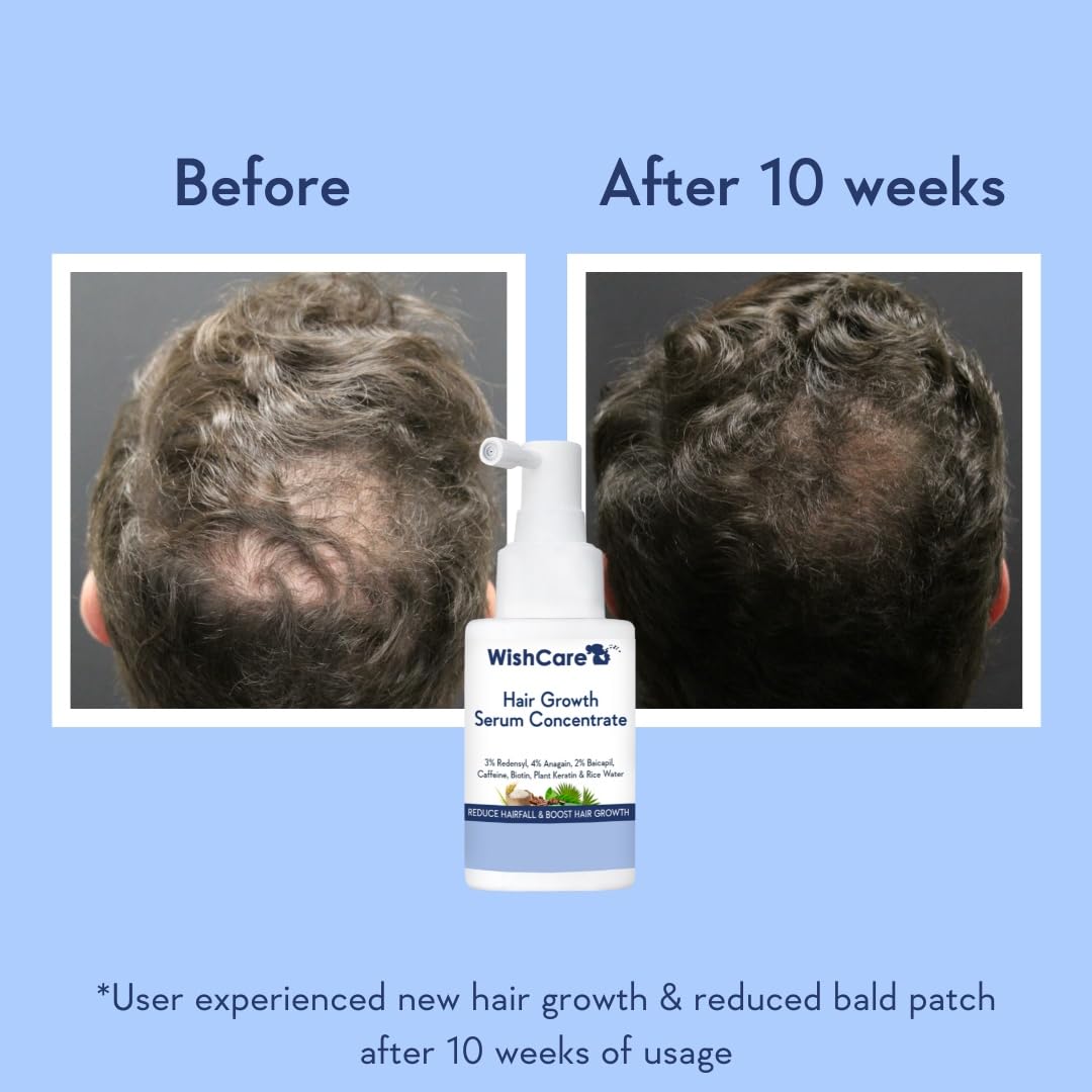 WishCare Hair Growth Serum UAE shown before and after results of new hair growth in 10 weeks